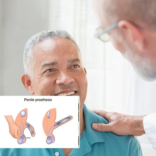 Why Choose High Pointe Surgery Center 
 for Your Penile Implant Surgery